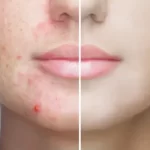 ¿Retinol para el acné? Sí ¿Cómo funciona?