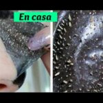 Elimina espinillas con nuestra mascarilla para abrir poros