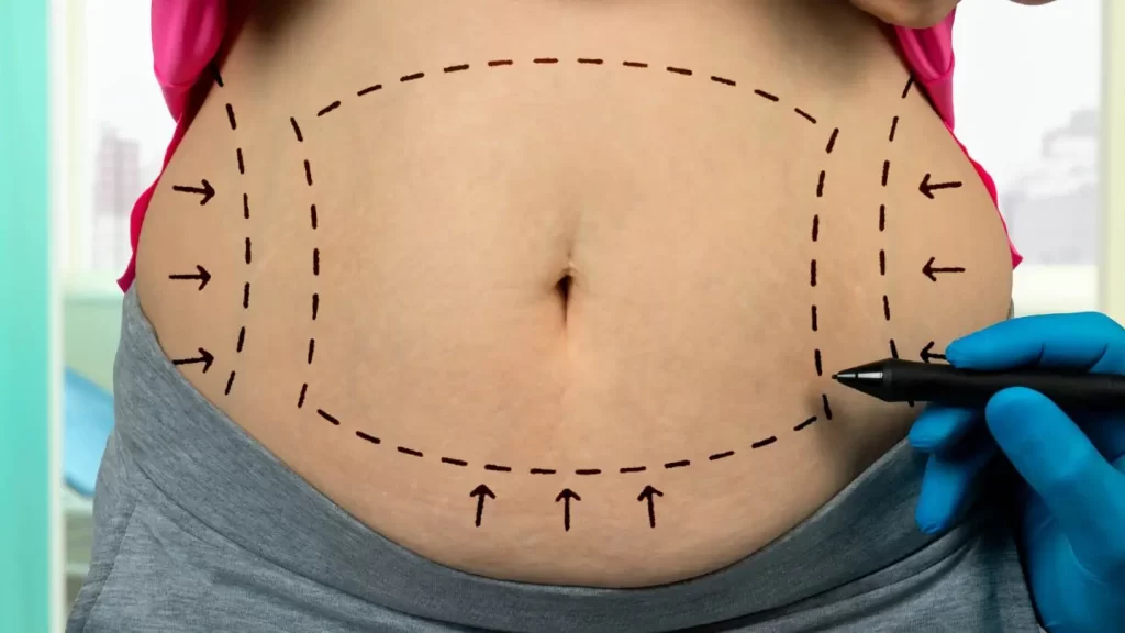 Todo lo que debes saber antes de hacerte una liposucción